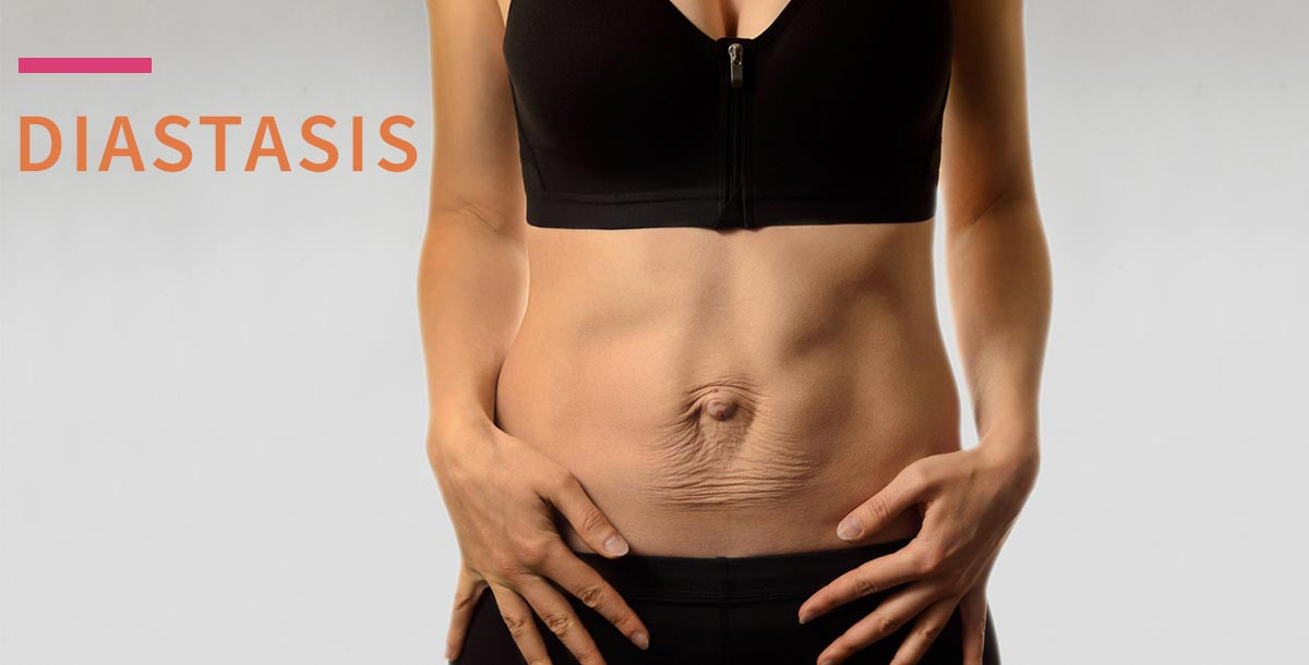 What Does a Gap in Your Abs Mean? (Distension or Diastasis)
